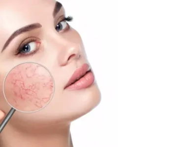 Rozasea (Gül Hastalığı)